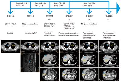 Case report: Sustained remission after combined sintilimab, anti-VEGF therapy, and chemotherapy in a patient with non-small cell lung cancer harboring acquired EGFR 19Del/T790M/cis-C797S mutation resistance